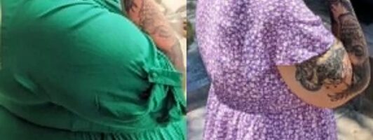 The Last 2.5 Years of My Life. Emergency C-section to Incisional Hernia Repair.